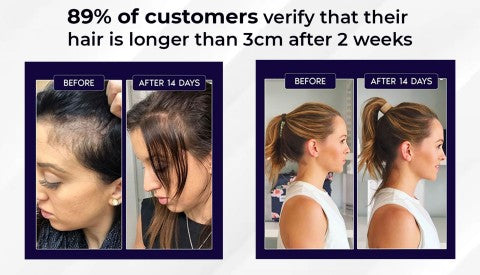 🖤Black Friday Sale:40% OFF🖤 HZA™ Natural Hair Regrowth Spray