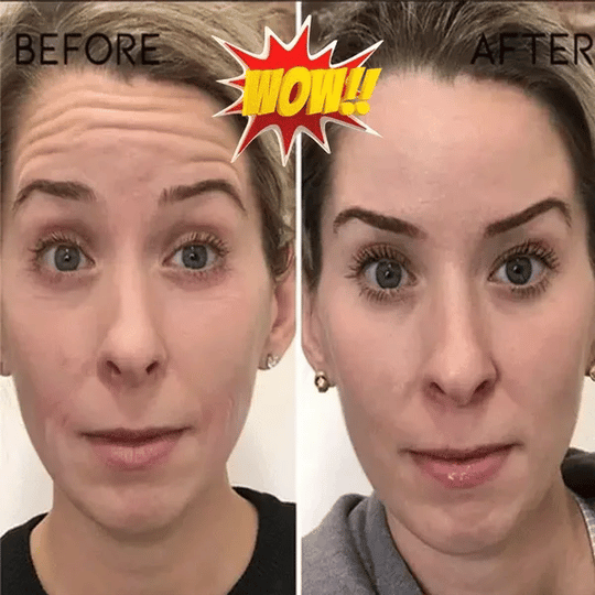 Hüaluroonhappe essents💦