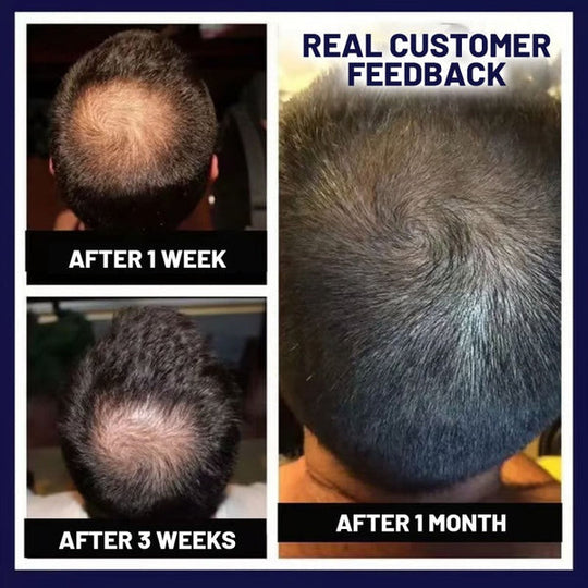 🖤Black Friday Sale:40% OFF🖤 HZA™ Natural Hair Regrowth Spray