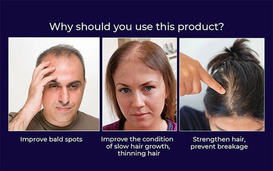 🖤Black Friday Sale:40% OFF🖤 HZA™ Natural Hair Regrowth Spray