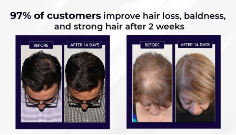 🖤Black Friday Sale:40% OFF🖤 HZA™ Natural Hair Regrowth Spray