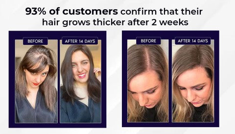 🖤Black Friday Sale:40% OFF🖤 HZA™ Natural Hair Regrowth Spray