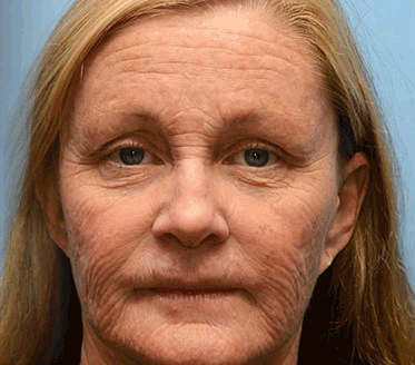 🖤Black Friday Sale:50% OFF🖤🧑‍⚕️TLOPA® Botox Bee Venom Wrinkle Removal Cream🔥