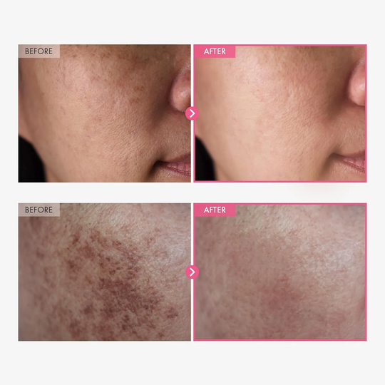 🖤Black Friday Sale:40% OFF🖤Arbutin 7% + Tranexamic Acid 4% Cream